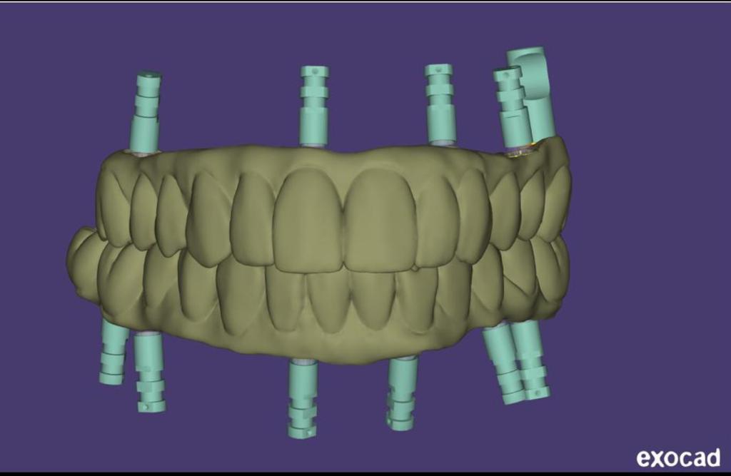 Facial Scanner Guided Full Arch On Patients Live Implant Training