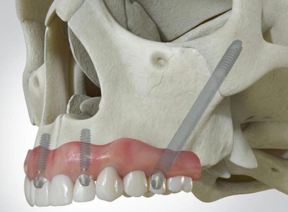 ZYGOMATIC PTERYGOID LIVE IMPLANT TRAINING