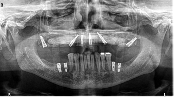 Maxillary Modification of an “all-on-4” by placing Pterygoid implants ...