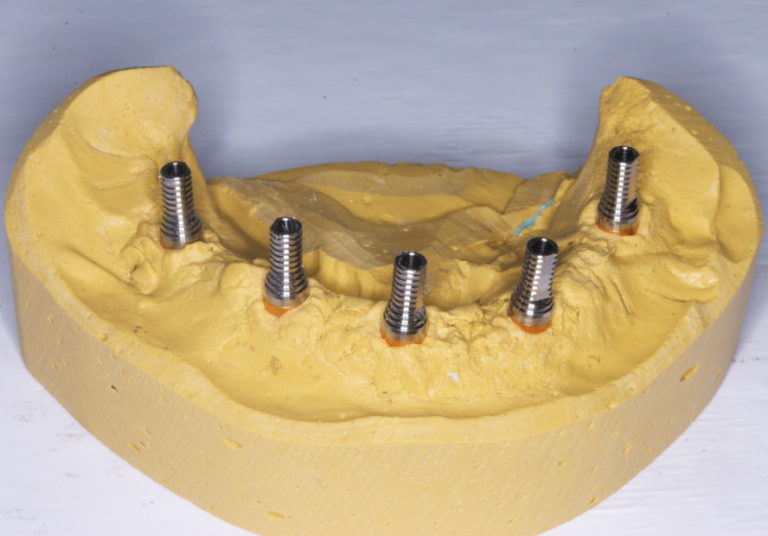 ABUTMENTS Live Implant Training ™ Work on Patients Dental Courses
