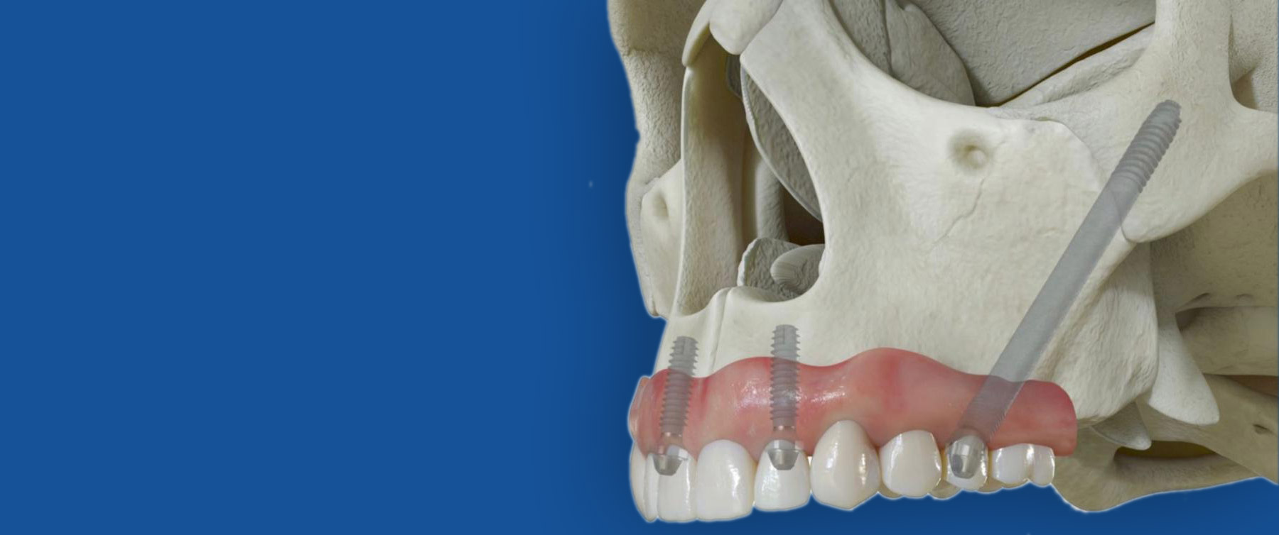 Zygomatic-pterygoid-course 