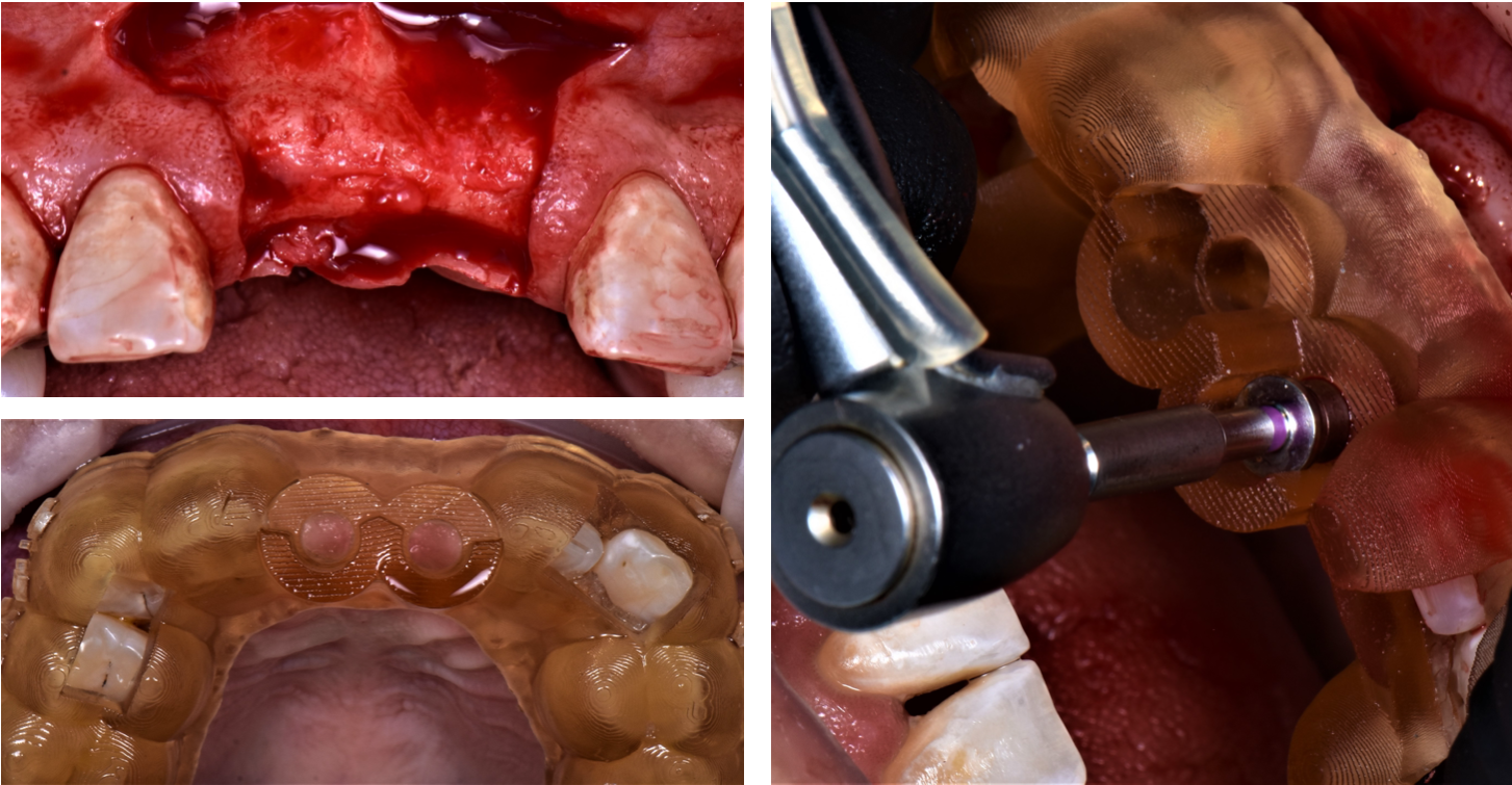 Computer-guided-surgeries-on-patients Case 1 d | Live Implant Training ...